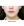Volnewmer (โวลนิวเมอร์ ยกกระชับด้วย RF) — หลังทำ (30วัน) · คลินิกศัลยกรรมตกแต่งนาบี