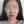 麗珠蘭（Rejuran Healer） — 術前 · Skinic醫美診所