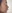 Nasal dorsum augmentation with implant (silicone/Gore-Tex) — Uri Plastic Surgery Clinic