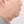 Platysma plication (corset platysmaplasty for double chin/jawline) — before (7days) · AB Plastic Surgery & Skin Clinic
