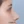 Nasal tip augmentation with donor (acellular) dermal matrix — after (15days) · Thank You Plastic Surgery