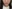 jaw angle reduction (mandibular angle osteotomy) — Uri Plastic Surgery Clinic