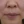 โบท็อกซ์ร่นร่องริมฝีปาก (Lip Flip ทำให้ร่องใต้จมูกดูสั้นลง) — ก่อนทำ (7วัน) · คลินิก Younme