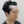 Hairline hair transplant (hairline lowering by grafting) — before (1days) · Vance Mosae Clinic