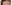 額縮小術（生え際下げ・ヘアライン下降術） — コウユ美容外科クリニック