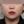 ELSA 超声波溶脂吸脂（面部溶脂） — 术后 (90天) · A Top医美诊所