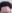 Forehead reduction (hairline lowering surgery) — The Fix Plastic Surgery Clinic