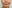 人中短縮（リップリフト） — プランナー美容外科クリニック