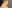 裏ハムラ法（経結膜的眼窩脂肪移動術） — メイト美容外科クリニック