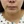 顔面非対称の矯正（顔の左右差修正） — 術前 (7日) · オンリフクリニック
