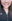 Dimple creation surgery (dimpleplasty) — Uri Plastic Surgery Clinic