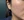 ฉีดสเต็มเซลล์ (Stem cell injection) — ก่อนทำ (30วัน) · คลินิก AB Aesthetic Surgery