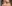 目の下のたるみ取り（下眼瞼形成・ハムラ法） — オブジェ美容外科クリニック