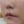 โบท็อกซ์ร่นร่องริมฝีปาก (Lip Flip ทำให้ร่องใต้จมูกดูสั้นลง) — ก่อนทำ (7วัน) · คลินิก Younme