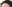 生え際の植毛（ヘアライン植毛） — 清潭OKクリニック