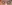 裏ハムラ法（経結膜的眼窩脂肪移動術） — アイフィット美容外科クリニック