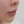 โบท็อกซ์ร่นร่องริมฝีปาก (Lip Flip ทำให้ร่องใต้จมูกดูสั้นลง) — หลังทำ (7วัน) · คลินิก Younme