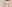 二の腕の脂肪吸引 — ソウル童顔クリニック