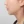 Platysma plication (corset platysmaplasty for double chin/jawline) — after (7days) · AB Plastic Surgery & Skin Clinic