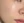 PRP skin rejuvenation (platelet-rich plasma therapy) — after (7days) · U&Me Clinic - Hongdae Branch
