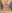 jaw angle reduction (mandibular angle osteotomy) — Uri Plastic Surgery Clinic