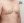 女性化乳房手術（男性の乳腺切除） — 術前 (15日) · ザ・美容外科