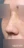Nasal osteotomy (nasal bone narrowing) — after (7days) · Anersty Plastic Surgery Clinic