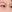 buried suture (non-incisional) double eyelid surgery — Yellow Plastic Surgery Clinic