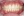 จัดฟันเฉพาะส่วนด้านใน 2D (2D lingual partial braces) — หลังทำ (112วัน) · คลินิกทันตกรรม Lucent