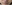 人中短縮（リップリフト） — ハイボム美容外科クリニック