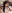 Full-face fat grafting (autologous fat transfer) — Mind Plastic Surgery