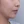 Surfect Lifting (4MHz monopolar RF lifting) — before (7days) · Only Lift Clinic