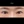 ผ่าตัดแก้ขนตาทิ่มตา (ขนตาแยงตา / เปลือกตาม้วนเข้า) — หลังทำ (14วัน) · รพ.ศัลยกรรมตกแต่งโอลโล