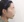 皮質骨切除術（下顎外板骨切り） — 術前 (60日) · アイルミ美容外科クリニック