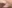 ほうれい線への脂肪注入（自家脂肪移植） — プレジャー美容外科クリニック
