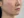 童颜针（舒颜萃/Sculptra）法令纹 — 术前 (30天) · Monster诊所
