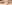 revision eyelid surgery (secondary blepharoplasty) — iNique Plastic Surgery & Aesthetics