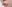 人中短縮（リップリフト） — ハイボム美容外科クリニック