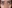 Lower Eyelid Fat Repositioning (transconjunctival) — Pleasure Plastic Surgery Clinic