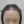 Scalp hair transplant — after (3days) · Vance Mosae Clinic