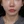 Density Lifting (RF skin tightening / lifting) — after · Ripain Clinic