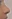 Nasal Tip Plasty with Autologous Cartilage — Litmus Plastic Surgery