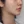 Density Lifting (RF skin tightening / lifting) — after · Ripain Clinic