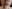Lip filler (lip augmentation with HA) — Dress Plastic Surgery Clinic