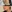 Thread lift — Balance Lab Plastic Surgery