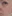 Rejuran Healer (salmon-DNA polynucleotide / PN skin booster) — Project U Clinic