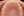 MTA orthodontics (Mini-Tube Appliance partial braces) — after (157days) · Lucent Dental Clinic