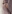 Breast augmentation with implants — The Body Plastic Surgery Clinic