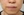 JUVGEN (autologous dermal regeneration / collagen-induction injection) — before (14days) · Saeroun Plastic Surgery