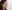 団子鼻修正（鼻尖縮小術） — ララ美容外科クリニック